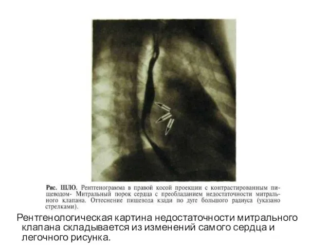 Рентгенологическая картина недостаточности митрального клапана складывается из изменений самого сердца и легочного рисунка.