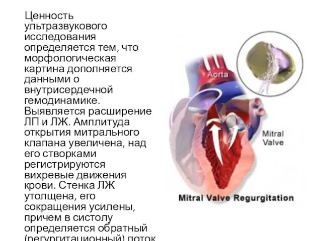 Ценность ультразвукового исследования определяется тем, что морфологическая картина дополняется данными о внутрисердечной гемодинамике.