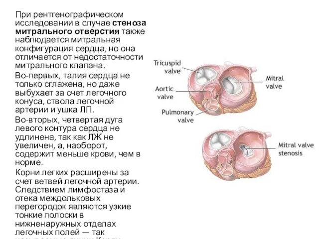 При рентгенографическом исследовании в случае стеноза митрального отверстия также наблюдается митральная конфигурация сердца,