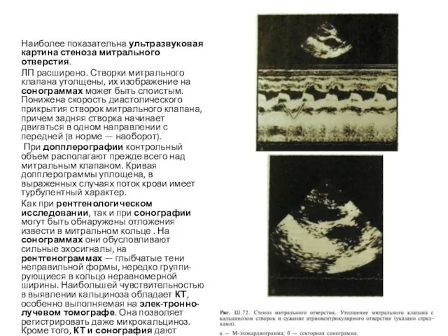 Наиболее показательна ультразвуковая картина стеноза митрального отверстия. ЛП расширено. Створки митрального клапана утолщены,