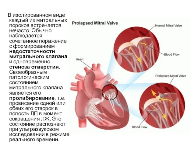 В изолированном виде каждый из митральных пороков встречается нечасто. Обычно