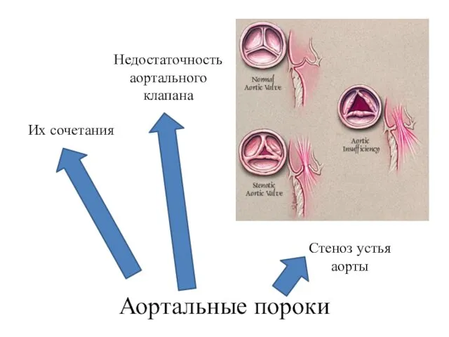 Аортальные пороки Стеноз устья аорты Недостаточность аортального клапана Их сочетания