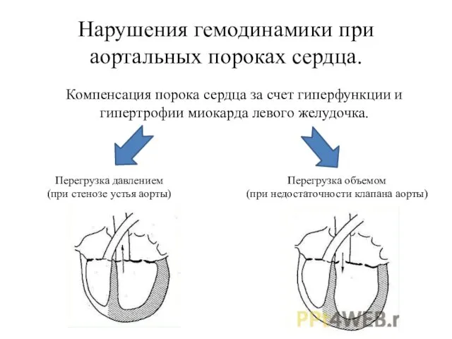 Нарушения гемодинамики при аортальных пороках сердца. Компенсация порока сердца за счет гиперфункции и