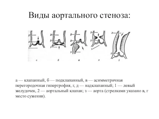 Виды аортального стеноза: а — клапанный, б — подклапанный, в — асимметричная перегородочная