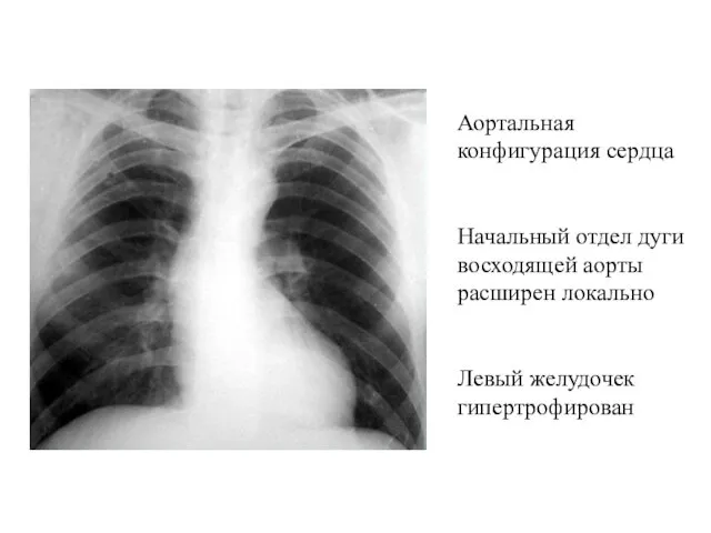 Аортальная конфигурация сердца Начальный отдел дуги восходящей аорты расширен локально Левый желудочек гипертрофирован