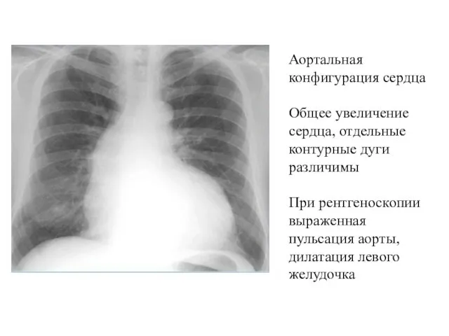 Аортальная конфигурация сердца Общее увеличение сердца, отдельные контурные дуги различимы При рентгеноскопии выраженная