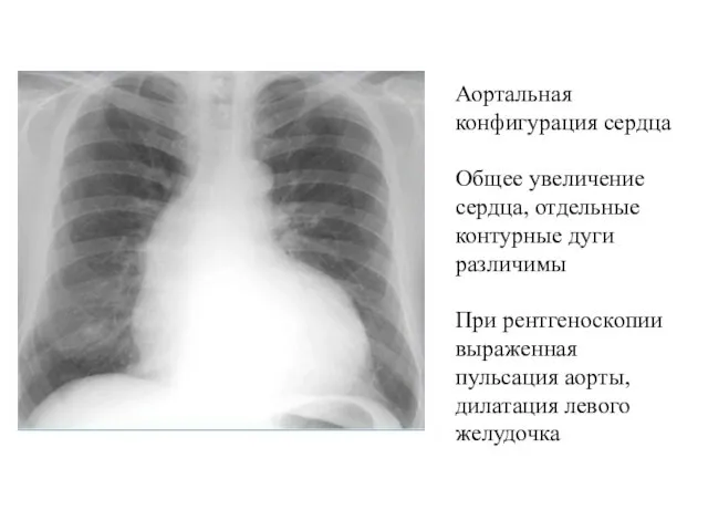 Аортальная конфигурация сердца Общее увеличение сердца, отдельные контурные дуги различимы