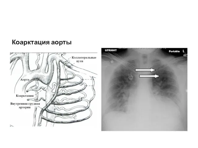 Коарктация аорты