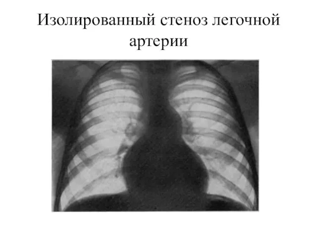 Изолированный стеноз легочной артерии