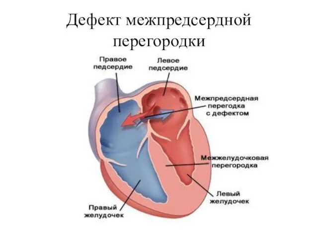 Дефект межпредсердной перегородки