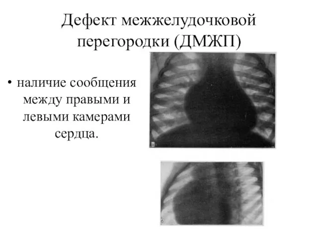 Дефект межжелудочковой перегородки (ДМЖП) наличие сообщения между правыми и левыми камерами сердца.