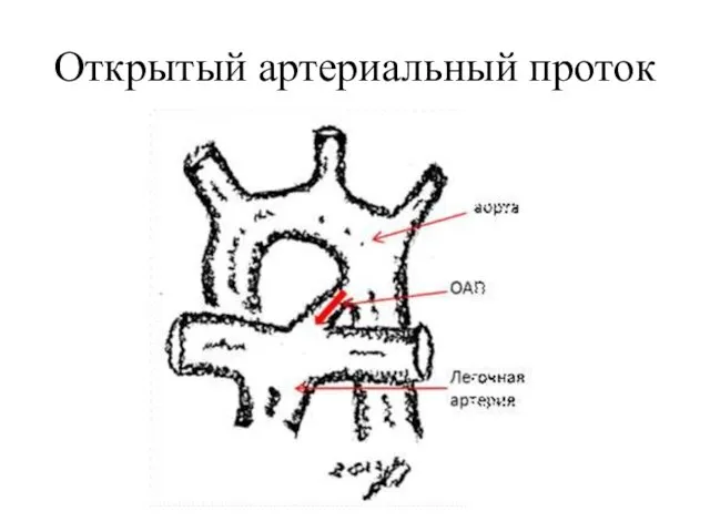 Открытый артериальный проток