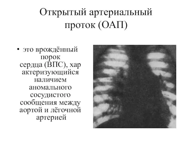 Открытый артериальный проток (ОАП) это врождённый порок сердца (ВПС), характеризующийся наличием аномального сосудистого