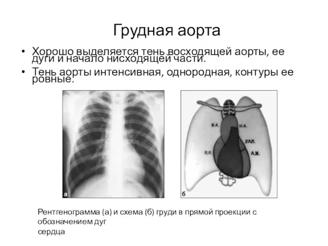 Грудная аорта Хорошо выделяется тень восходящей аорты, ее дуги и начало нисходящей части.