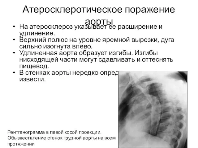 Атеросклеротическое поражение аорты На атеросклероз указывает ее расширение и удлинение.