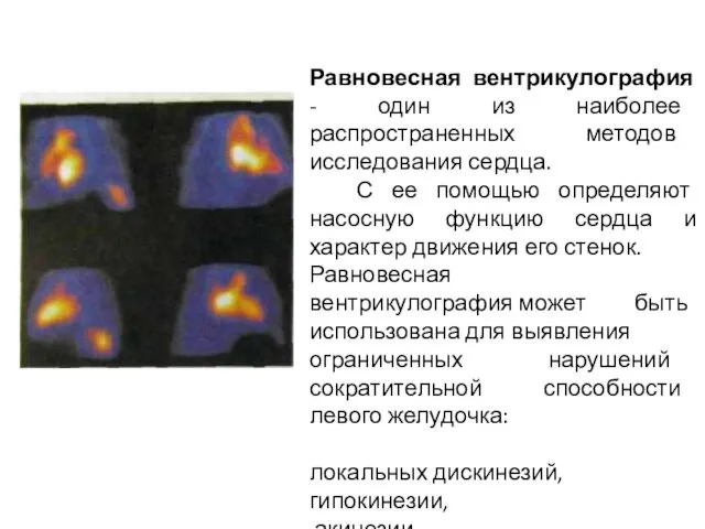 Равновесная вентрикулография - один из наиболее распространенных методов исследования сердца.