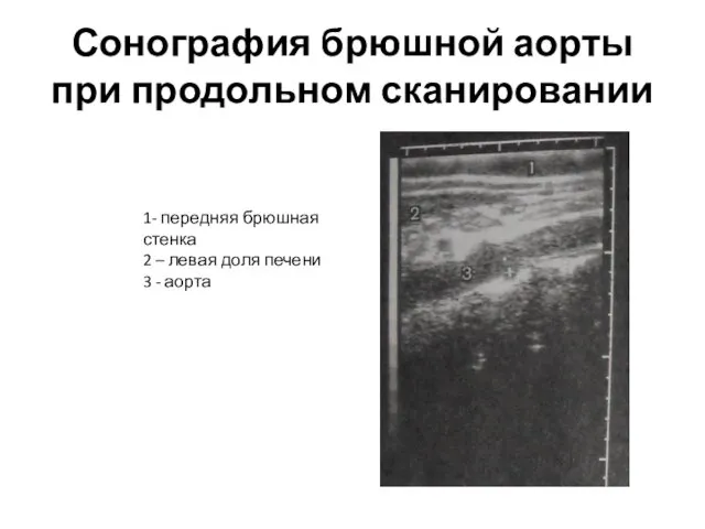 Сонография брюшной аорты при продольном сканировании 1- передняя брюшная стенка 2 – левая