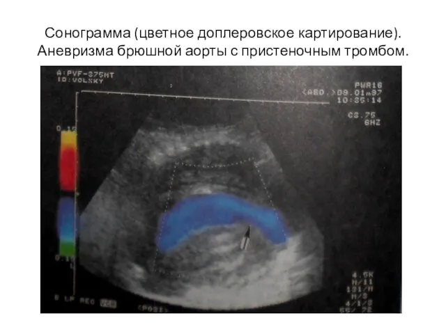 Сонограмма (цветное доплеровское картирование). Аневризма брюшной аорты с пристеночным тромбом.