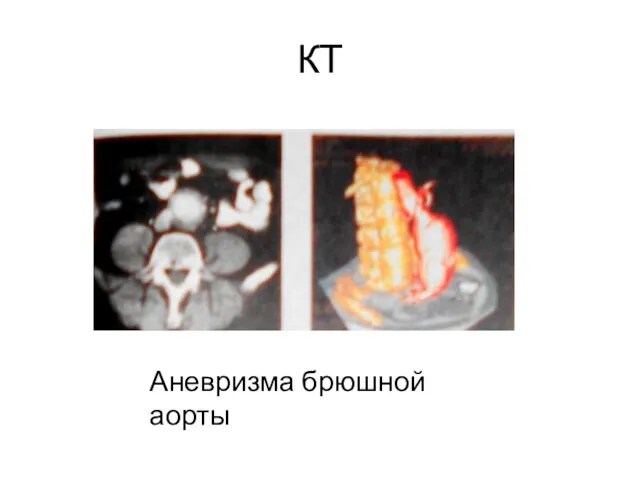 КТ Аневризма брюшной аорты