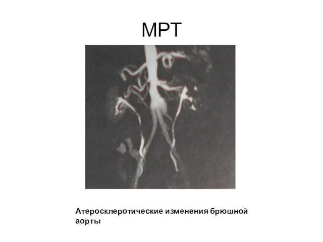 МРТ Атеросклеротические изменения брюшной аорты