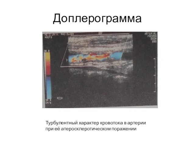 Доплерограмма Турбулентный характер кровотока в артерии при её атеросклеротическом поражении