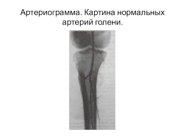 Артериограмма. Картина нормальных артерий голени.