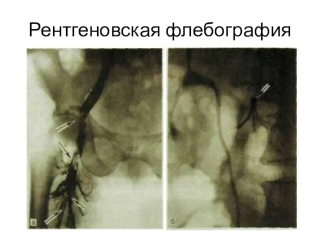 Рентгеновская флебография
