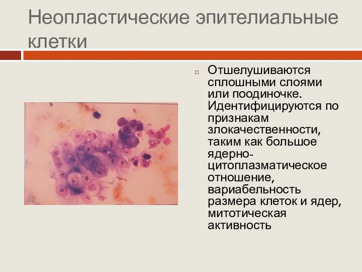 Неопластические эпителиальные клетки Отшелушиваются сплошными слоями или поодиночке. Идентифицируются по