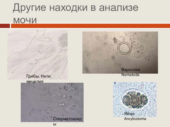 Другие находки в анализе мочи Сперматозоиды Грибы. Нити мицелия Яйцо Ancylostoma Взрослая Nematoda