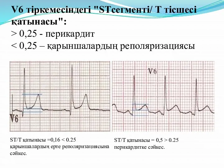 V6 тіркемесіндегі "STсегменті/ T тісшесі қатынасы": > 0,25 - перикардит