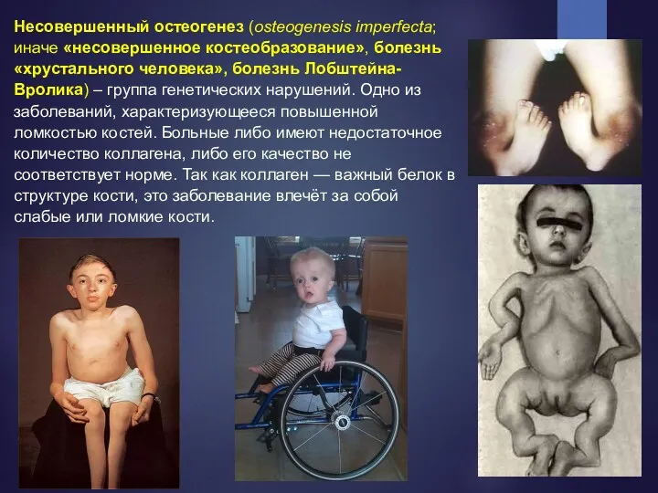 Несовершенный остеогенез (osteogenesis imperfecta; иначе «несовершенное костеобразование», болезнь «хрустального человека»,