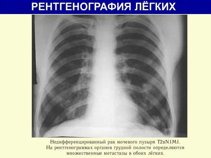 РЕНТГЕНОГРАФИЯ ЛЁГКИХ