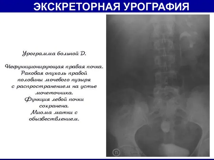 ЭКСКРЕТОРНАЯ УРОГРАФИЯ