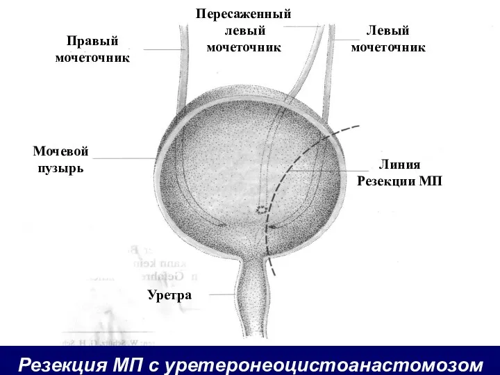 Резекция МП с уретеронеоцистоанастомозом Правый мочеточник Мочевой пузырь Уретра Пересаженный