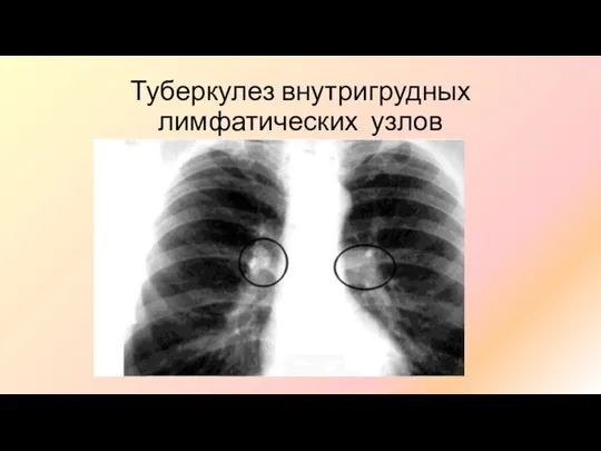 Туберкулез внутригрудных лимфатических узлов