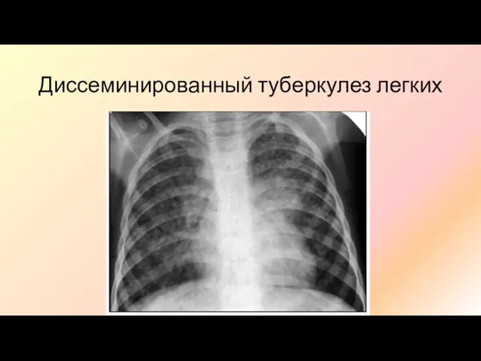 Диссеминированный туберкулез легких