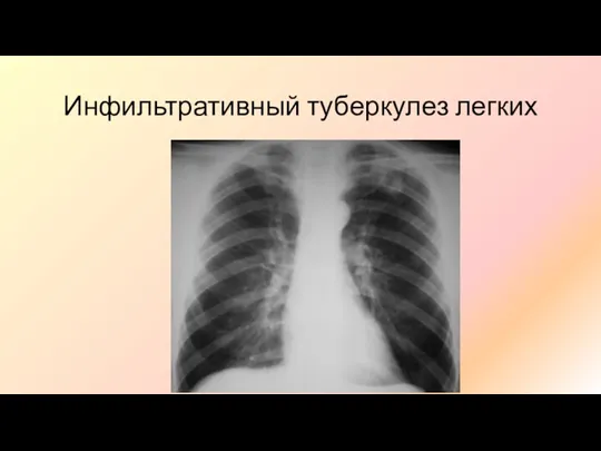 Инфильтративный туберкулез легких