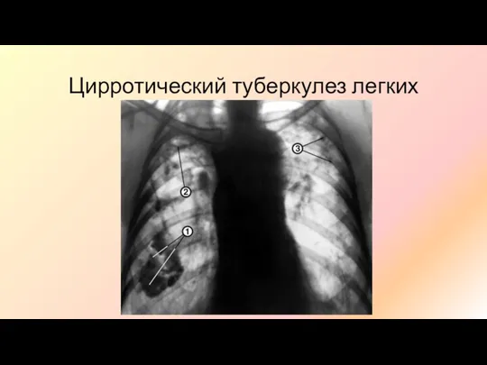 Цирротический туберкулез легких