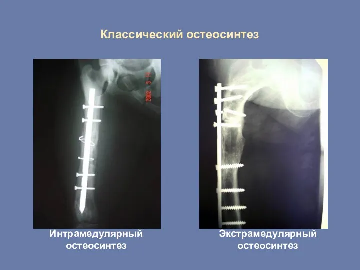 Классический остеосинтез Интрамедулярный остеосинтез Экстрамедулярный остеосинтез