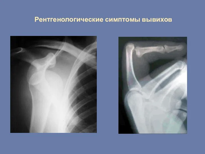 Рентгенологические симптомы вывихов