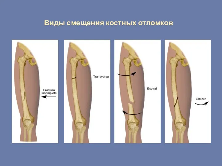 Виды смещения костных отломков