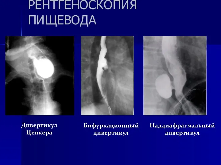 КОНТРАСТНАЯ РЕНТГЕНОСКОПИЯ ПИЩЕВОДА Дивертикул Ценкера Бифуркационный дивертикул Наддиафрагмальный дивертикул