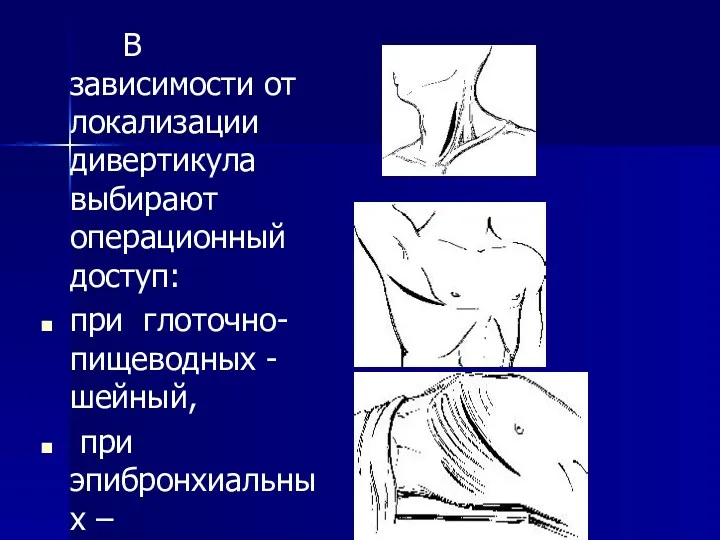 В зависимости от локализации дивертикула выбирают операционный доступ: при глоточно-пищеводных