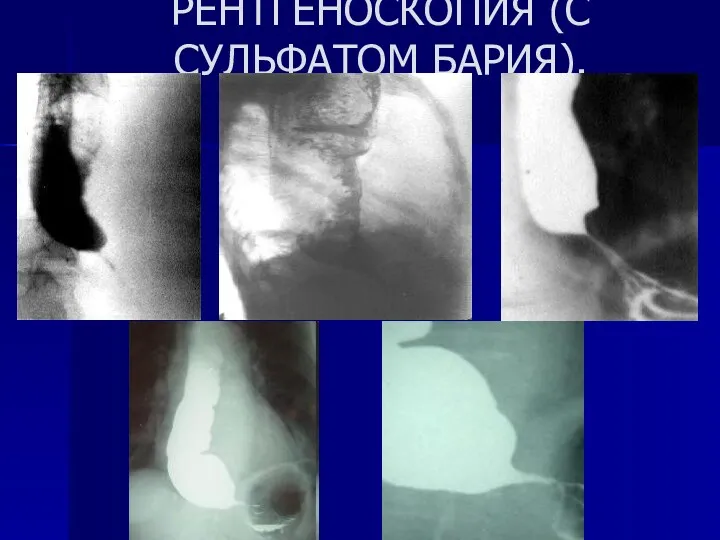 КОНТРАСТНАЯ РЕНТГЕНОСКОПИЯ (С СУЛЬФАТОМ БАРИЯ).