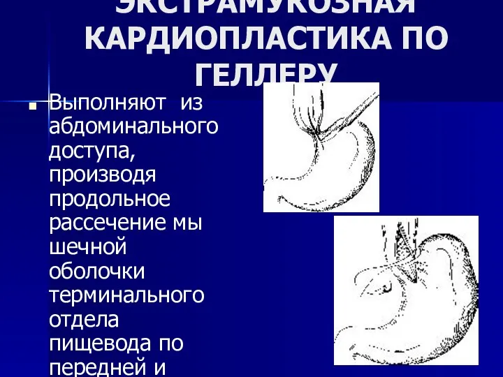 ЭКСТРАМУКОЗНАЯ КАРДИОПЛАСТИКА ПО ГЕЛЛЕРУ Выполняют из абдоминального доступа, производя продольное