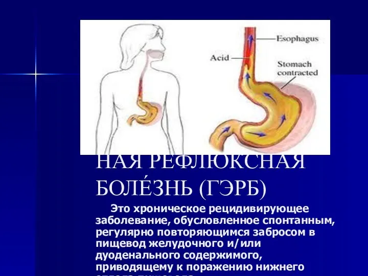 ГАСТРОЭЗОФАГЕА́ЛЬНАЯ РЕФЛЮ́КСНАЯ БОЛЕ́ЗНЬ (ГЭРБ) Это хроническое рецидивирующее заболевание, обусловленное спонтанным,