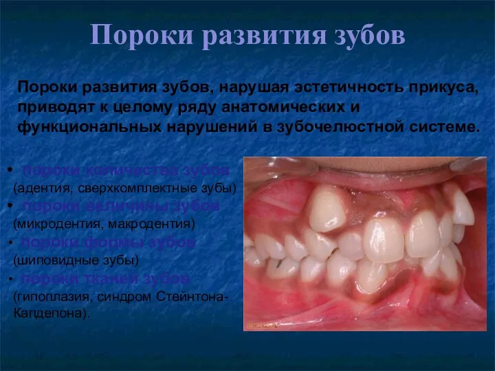 Пороки развития зубов пороки количества зубов (адентия, сверхкомплектные зубы) пороки величины зубов (микродентия,