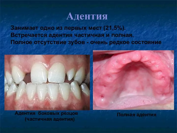 Адентия Адентия боковых резцов (частичная адентия) Полная адентия Занимает одно