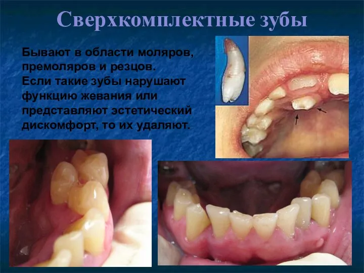 Сверхкомплектные зубы Адентия 12 и 22 зубов Бывают в области моляров, премоляров и