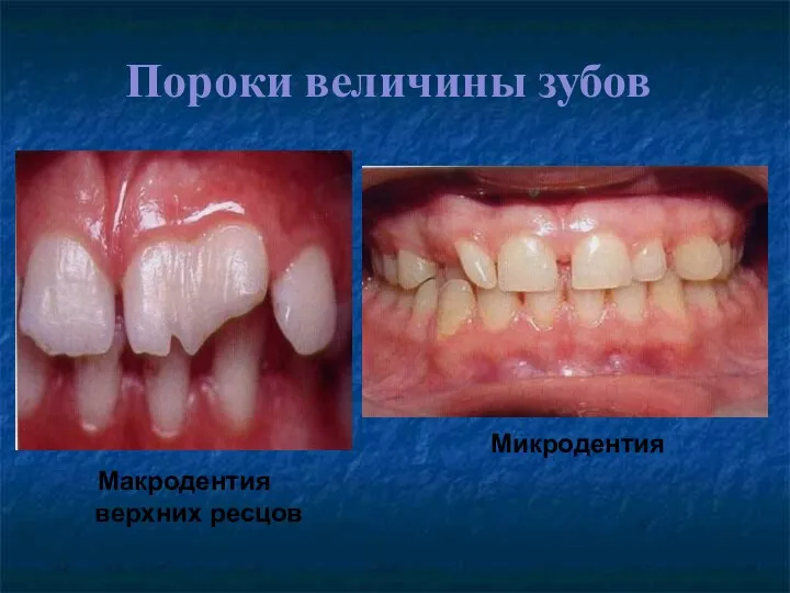 Пороки величины зубов Макродентия верхних ресцов Микродентия